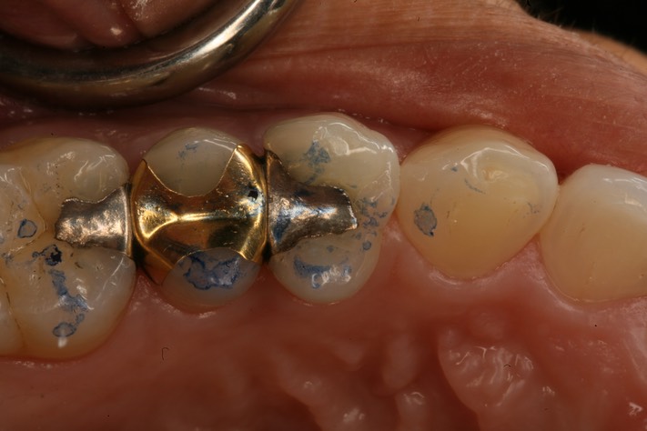 Brandon Yokota #12 pre-op