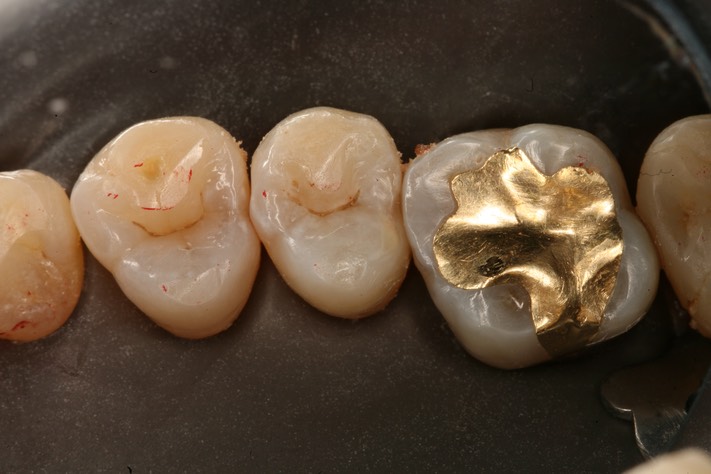 Roland Ylarde #4 pre-op with dam