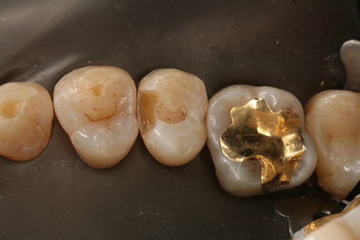 Roland Ylarde #4 caries removal