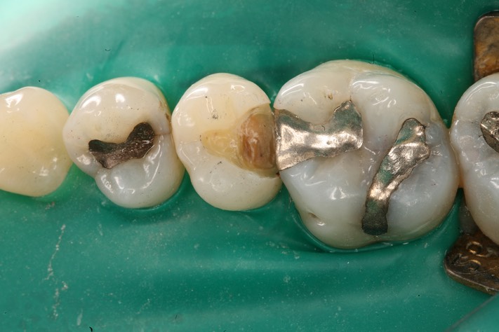 MItchell Chun #4 caries removal