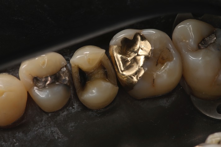 Gary Umeda #3 - 4 pre-op