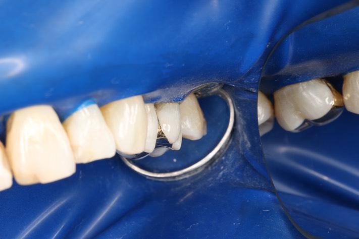 Mark Chun #14 buccal view