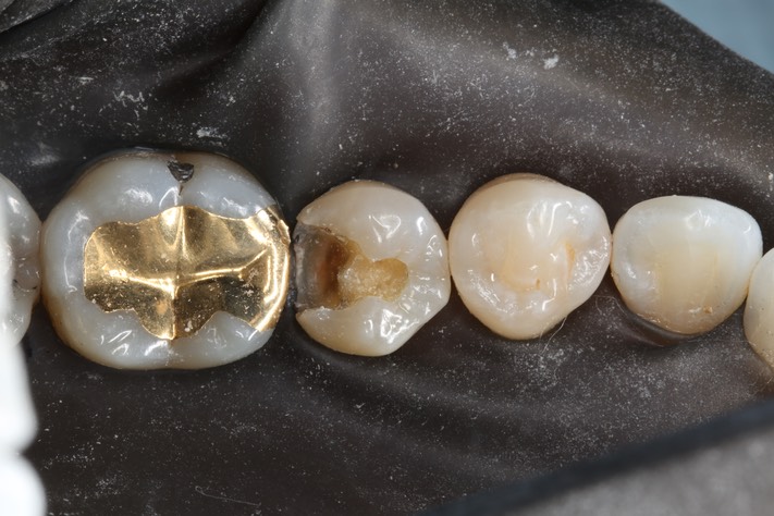 Brian Sato #29 amalgam removal