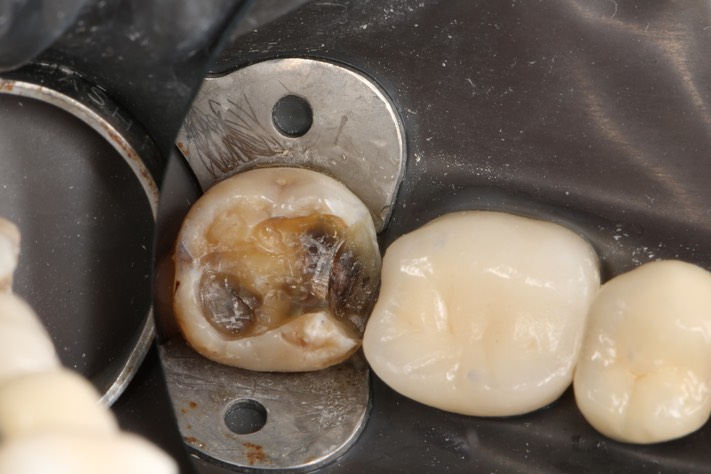 Wayne Chin #31 amalgam removal