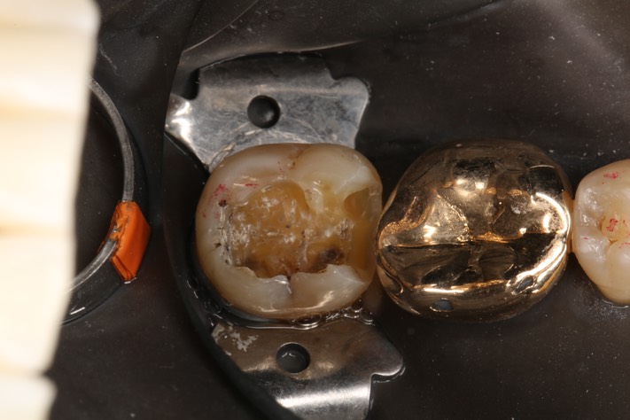 Alan Chinn #31 amalgam removal