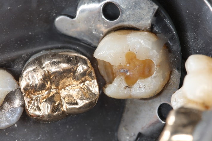 Russ Tabata #18 amalgam removal