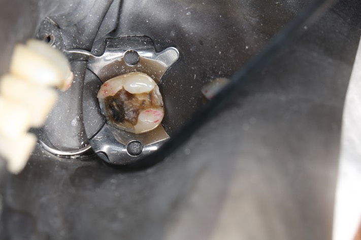 Scott Kanamori #31 amalgam removal