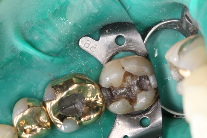 Mendel Sato #18 amalgam removal