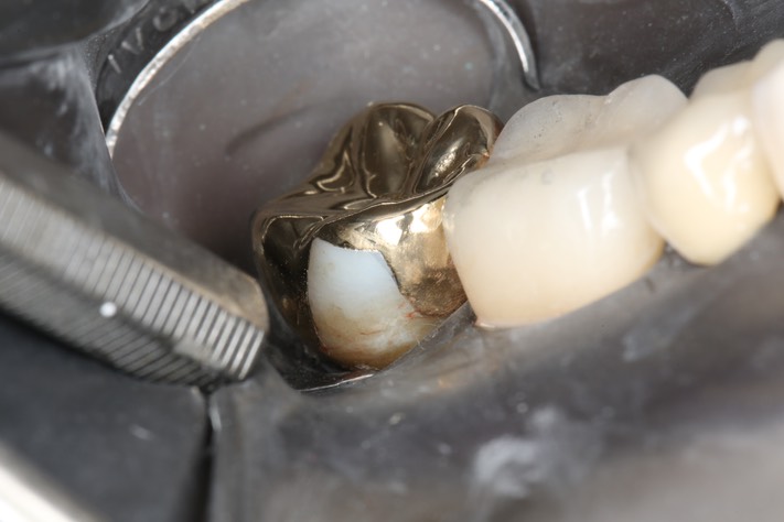 Wayne Chin #31 finish - buccal view