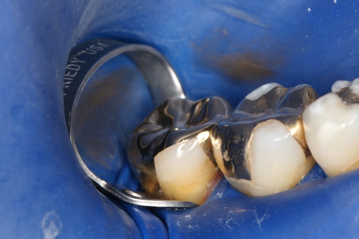 Mark Chun #31 buccal view