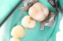 Wes Sato #4 amalgam removal