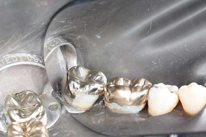 Russ Tabata #18 finish buccal view