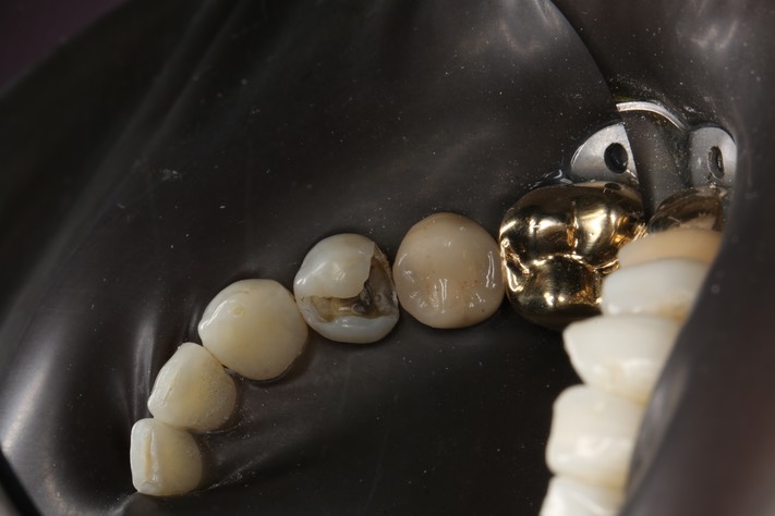 Wayne Chin #21 caries removal