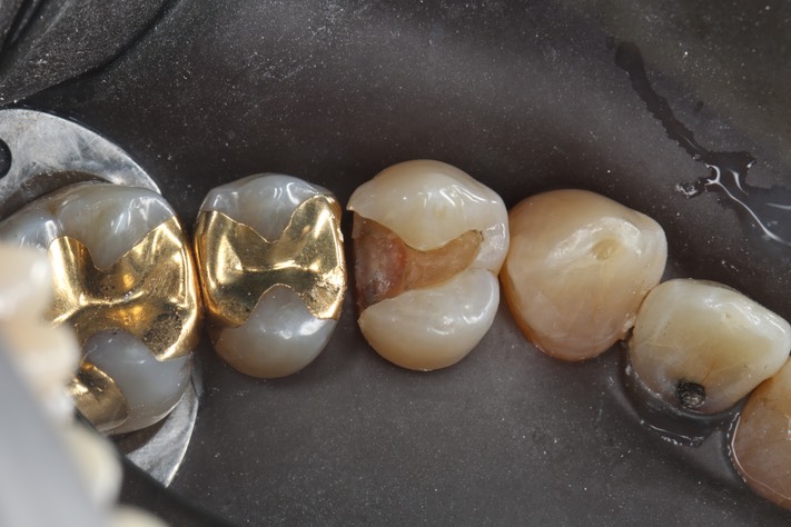 Alan Tamashiro #12 amalgam removal