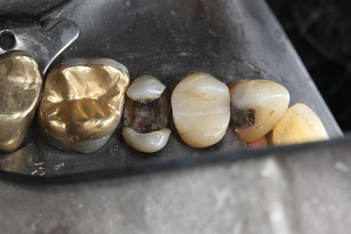 Mendel Sato #13 amalgam removal