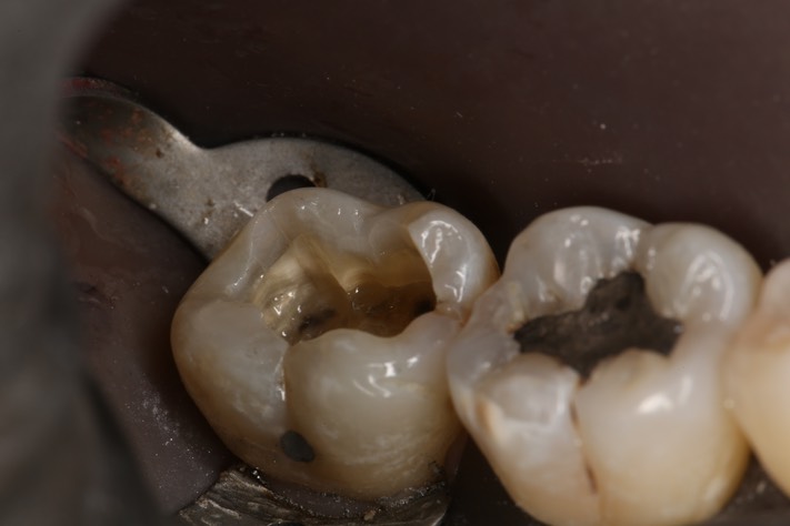 Larry Fujioka #31 vertical fracture