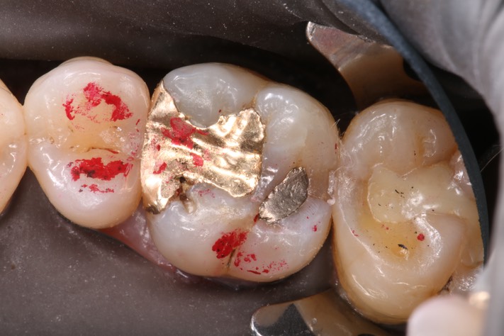 Kyle Chock #3 pre-op