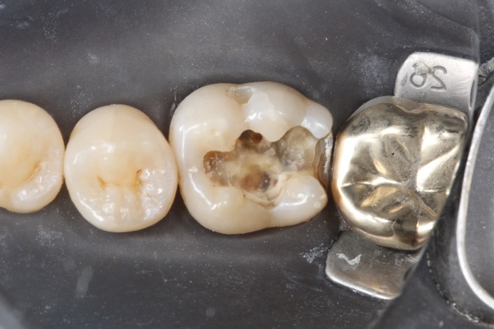 Gary Umeda #19 caries removal