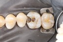 Scott Kanamori #3 caries removal