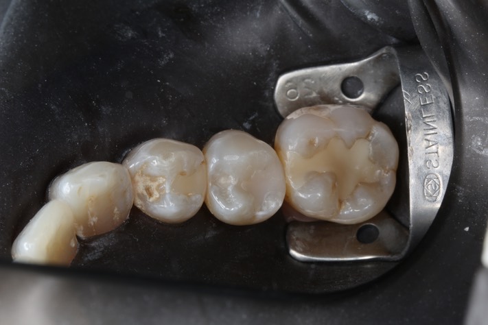 Gary Umeda #20 pre-op