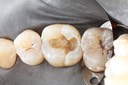 Alan Chinn #3 caries removal