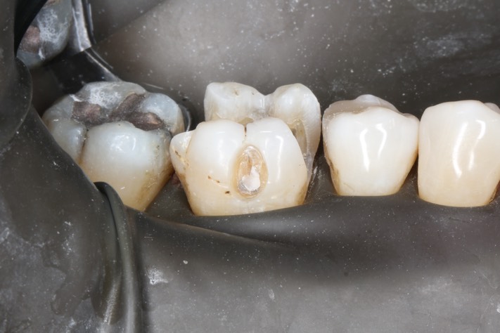 Frank Fukuda #30 buccal prep