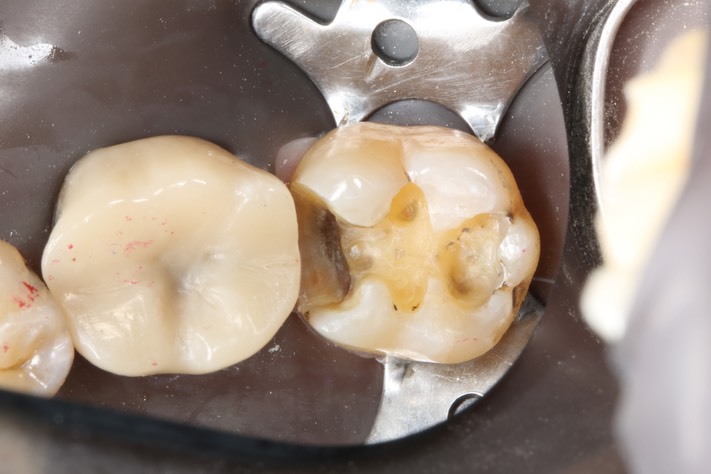 Alan Tamashiro #18 caries removal