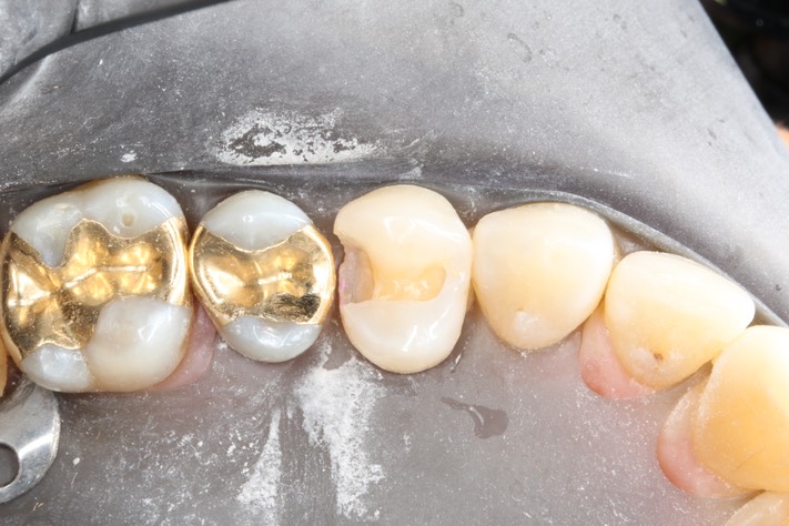 Chris Woo #12 caries removal