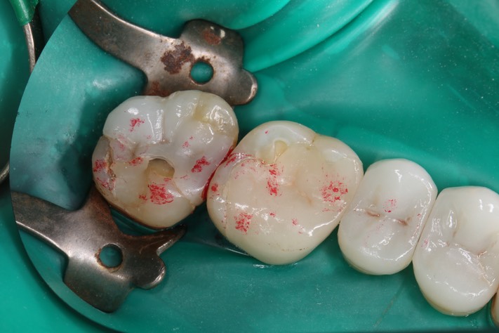 Mendel Sato #15 pre-op