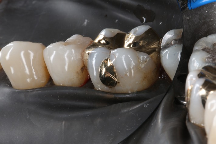 Frank Fukuda #30 buccal