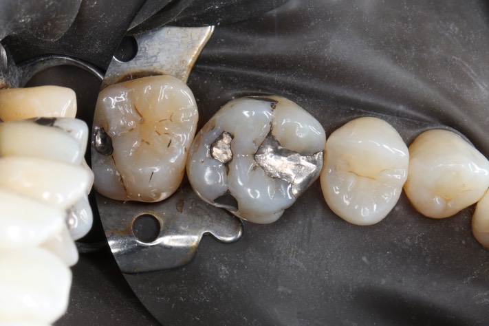 Brandon Yokota #3 pre-op