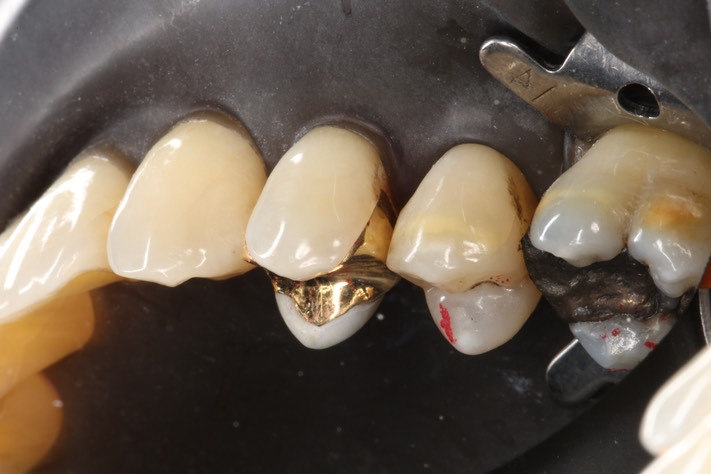 Alan Chinn #5 try in - buccal view