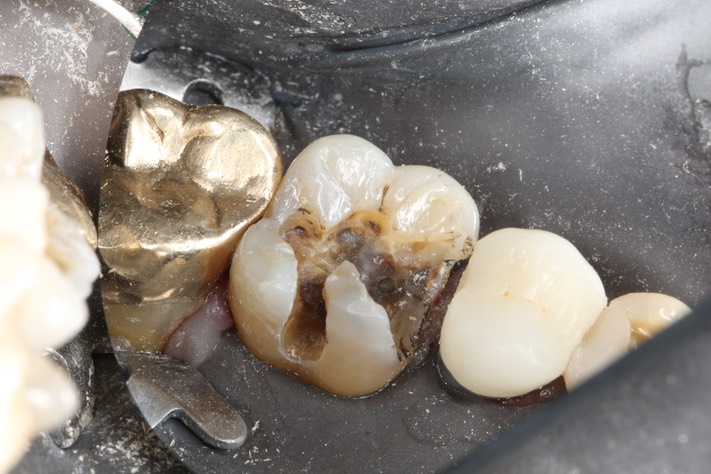 Wes Sato #14 caries removal