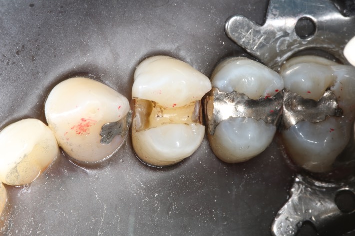 Bryan Sato #5 amalgam removal