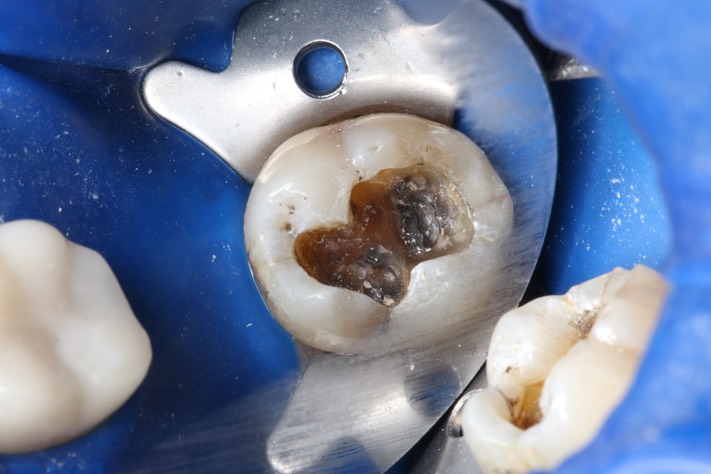 Mark Chun #17 amalgam removal