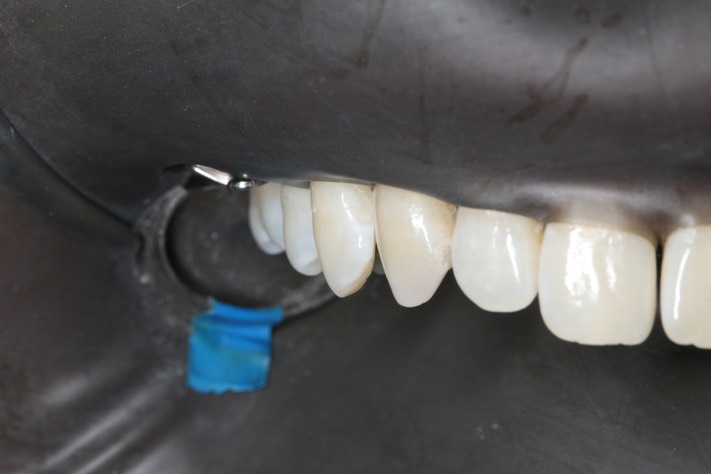 Bryan Sato #5 buccal view