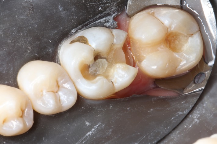 Gary Umeda #18-19 composite removal