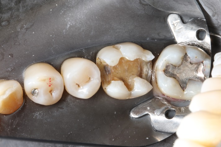 Alan Chinn #19 caries removal