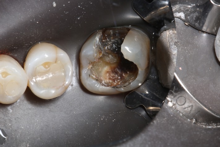 Matt Dodson #19 amalgam removal