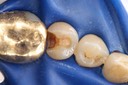 Mark Chun #29 caries removal