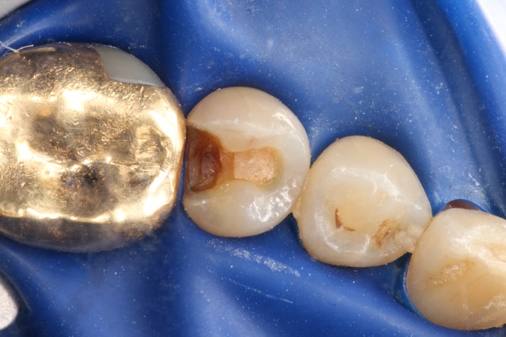 Mark Chun #29 caries removal