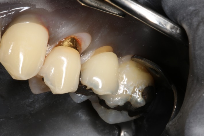 Gary Umeda #13 pre-op buccal