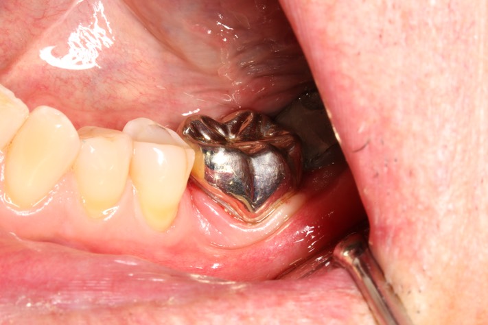 Matt Dodson #18 buccal view