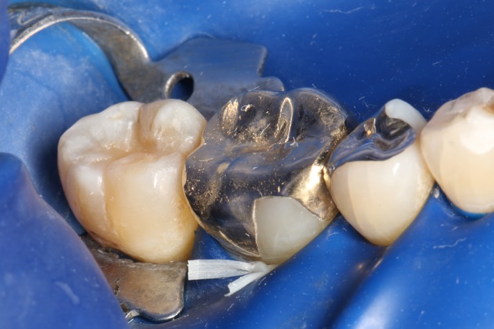 Mark Chun #29 buccal view