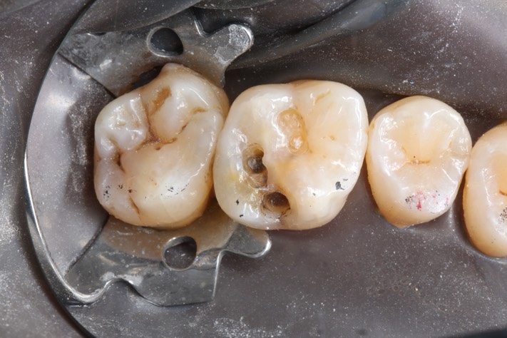 Kyle Chock #14 caries removal