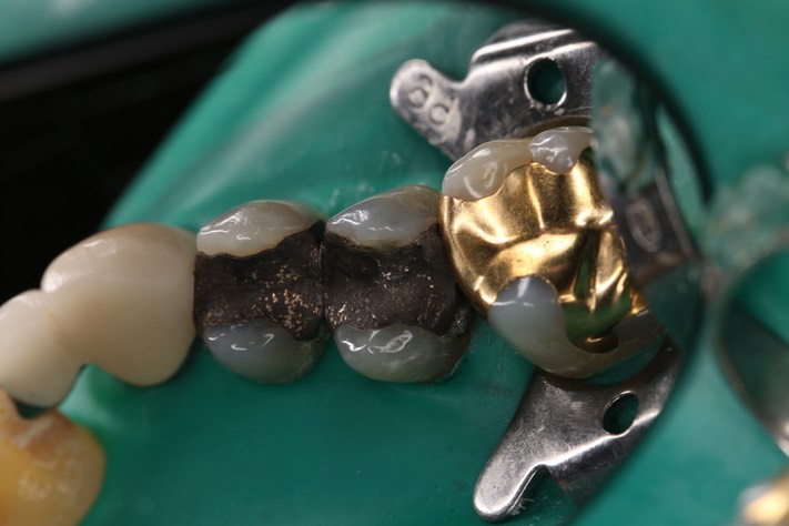 Mendel Sato #4 pre-op