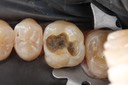 Matt Dodson #3 caries removal