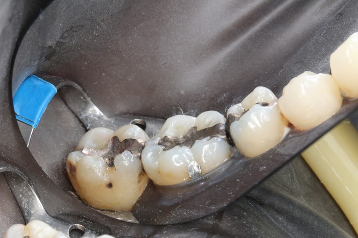 Frank Fukuda #18 pre-op buccal view