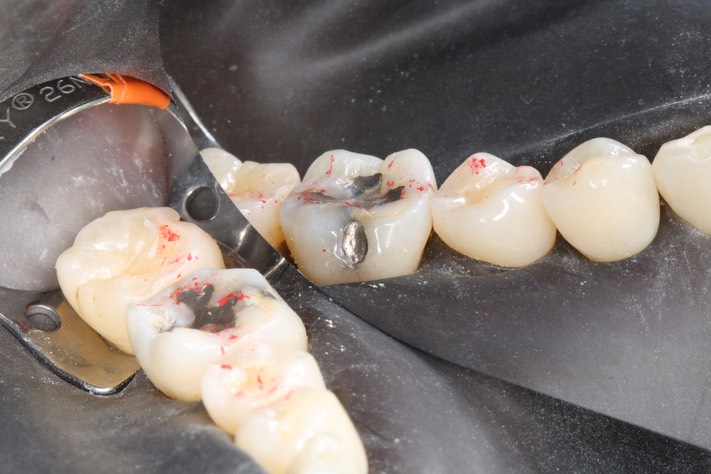 Alan Chinn #19 pre-op buccal view