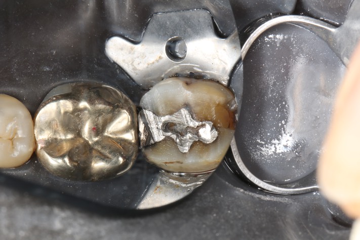 Kyle Chock #18 occlusal reduction